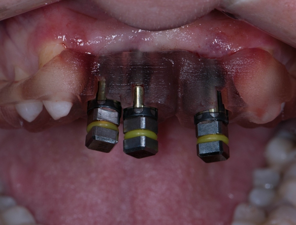 Single Tooth Implant