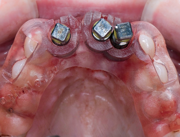 Single Tooth Implant