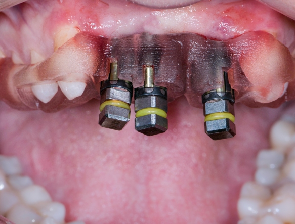 Single Tooth Implant